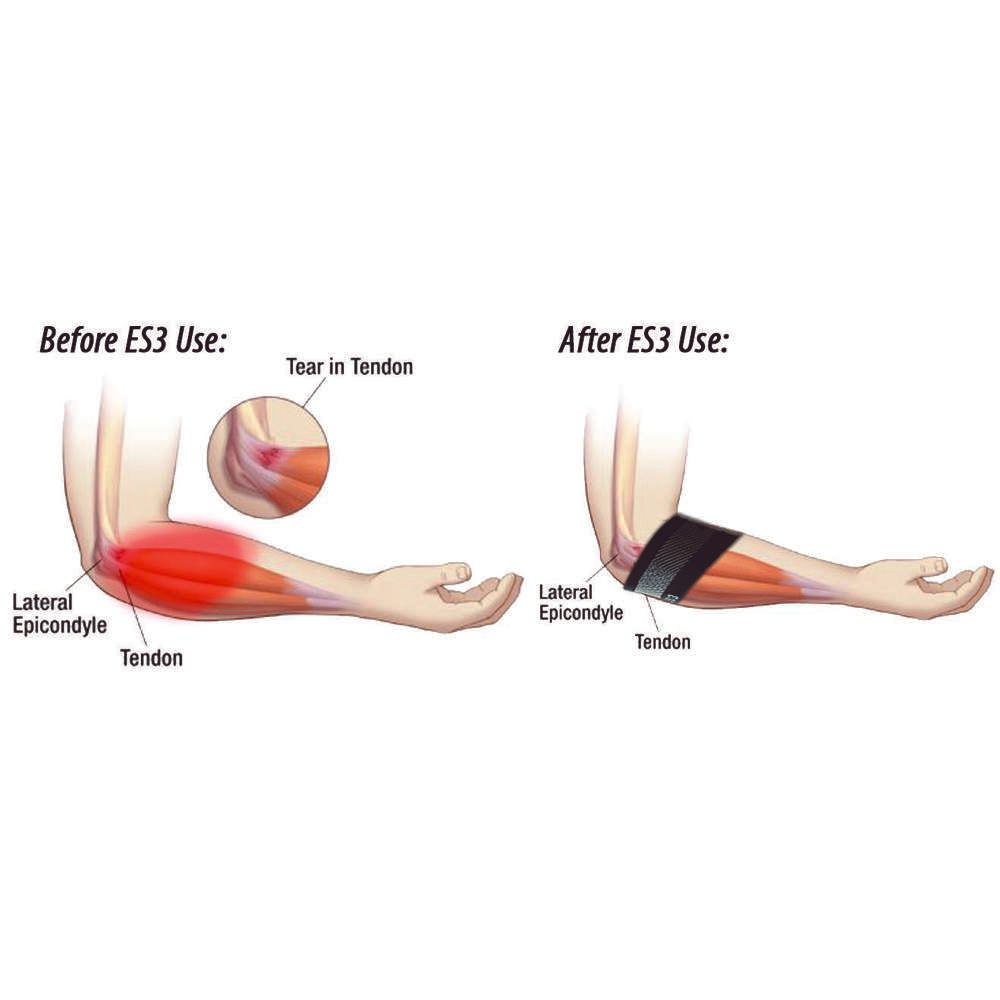 Elbow Compression Sleeve For Bursitis (ES3) - Black - Image 3